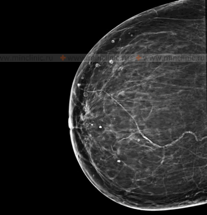 Depending on the prevalence of the altered type of breast tissue, different types of mastopathy are distinguished.